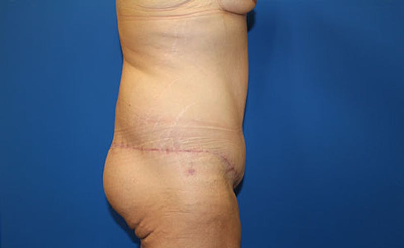 Body Lift Before & After Gallery - Patient 417540 - Image 6