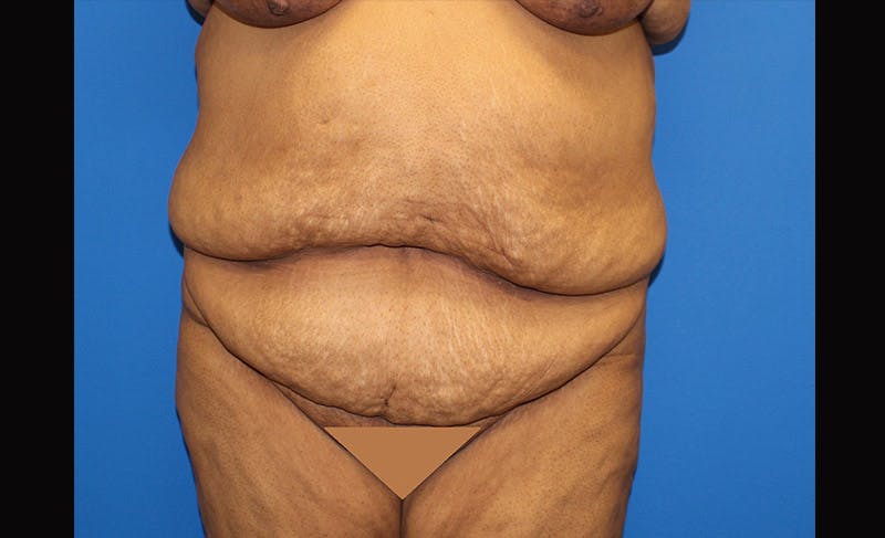 Body Lift Before & After Gallery - Patient 871723 - Image 1