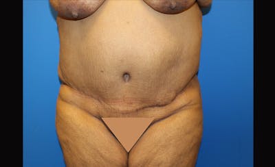 Body Lift Before & After Gallery - Patient 871723 - Image 2