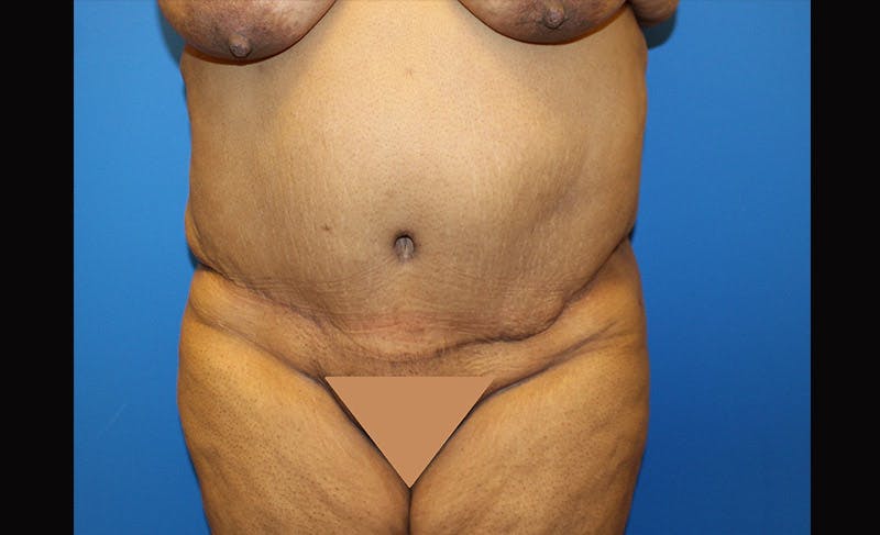 Body Lift Before & After Gallery - Patient 871723 - Image 2