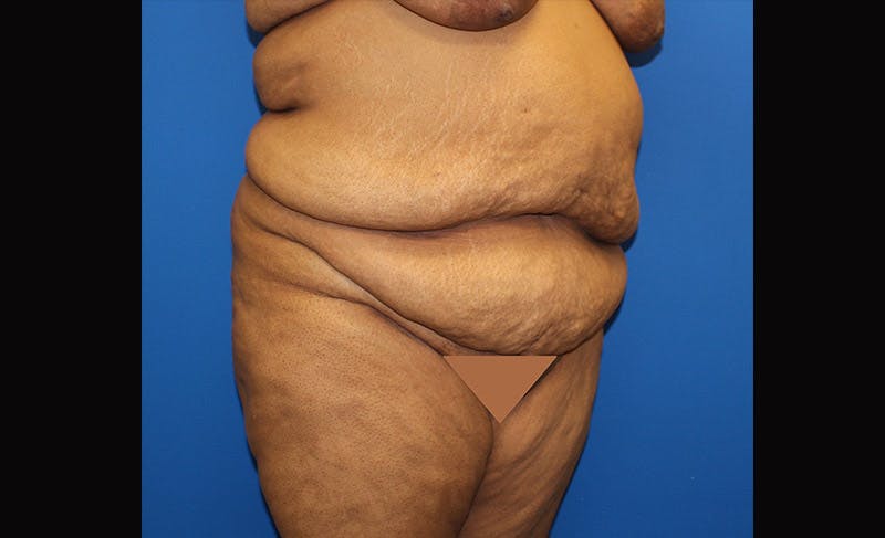 Body Lift Before & After Gallery - Patient 871723 - Image 3