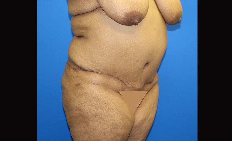 Body Lift Before & After Gallery - Patient 871723 - Image 4