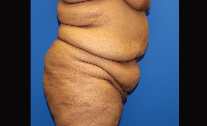 Body Lift Before & After Gallery - Patient 871723 - Image 5