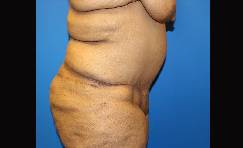 Body Lift Before & After Gallery - Patient 871723 - Image 6