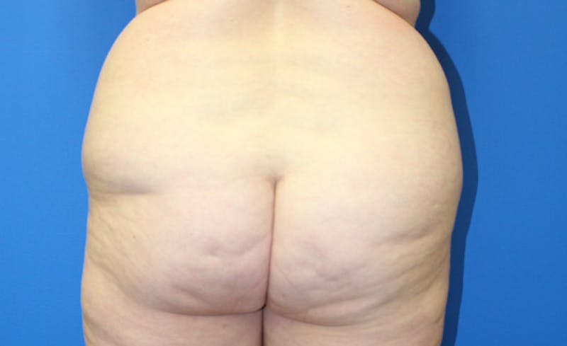Brazilian Butt Lift Before & After Gallery - Patient 833544 - Image 1