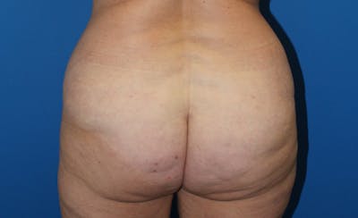 Brazilian Butt Lift Before & After Gallery - Patient 833544 - Image 2