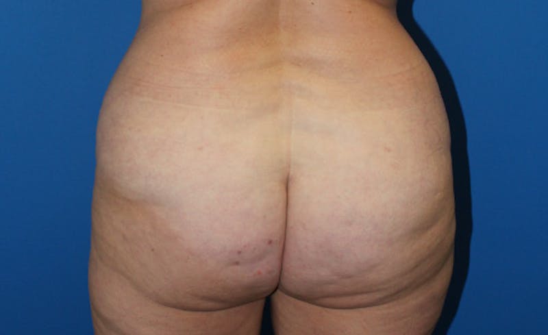 Brazilian Butt Lift Before & After Gallery - Patient 833544 - Image 2