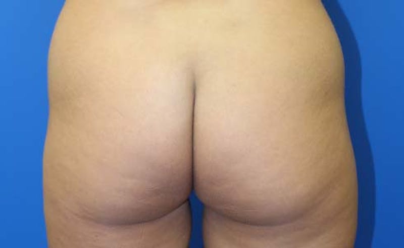 Brazilian Butt Lift Before & After Gallery - Patient 240079 - Image 1