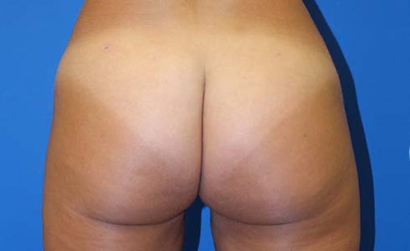 Brazilian Butt Lift Before & After Gallery - Patient 240079 - Image 2