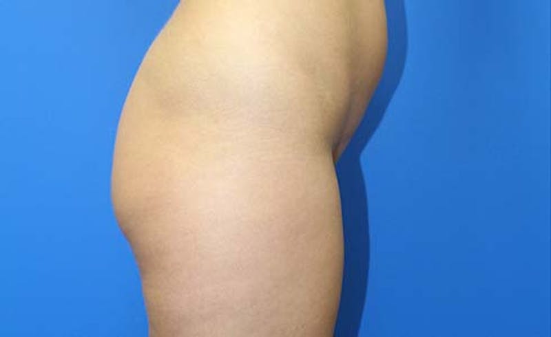 Brazilian Butt Lift Before & After Gallery - Patient 240079 - Image 3