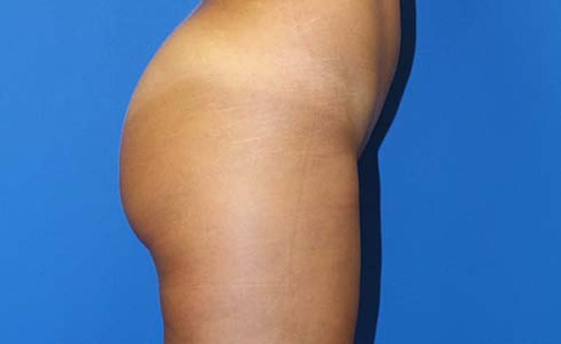 Brazilian Butt Lift Before & After Gallery - Patient 240079 - Image 4