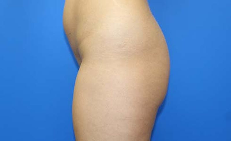 Brazilian Butt Lift Before & After Gallery - Patient 240079 - Image 5