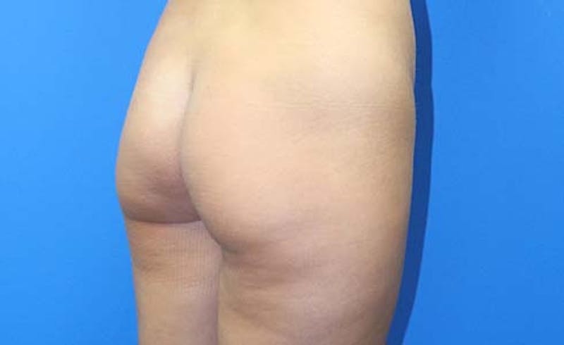 Brazilian Butt Lift Before & After Gallery - Patient 240079 - Image 7