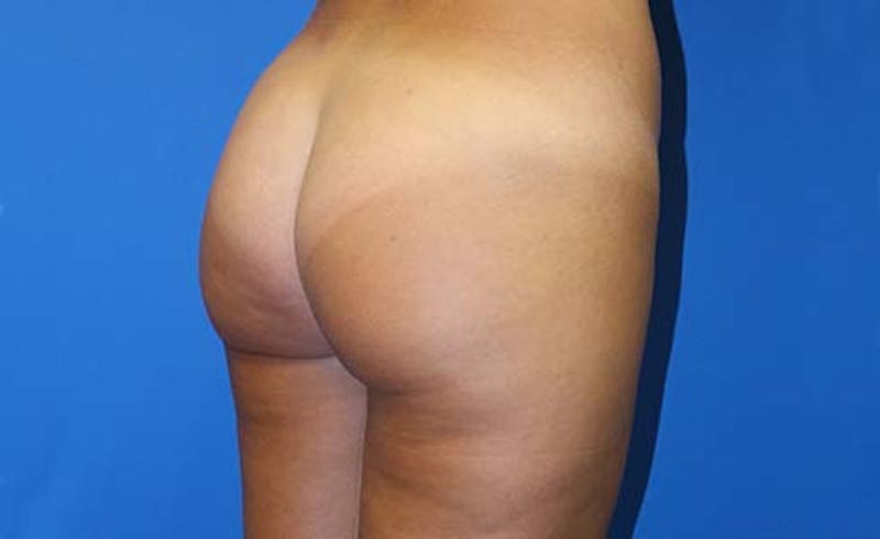 Brazilian Butt Lift Before & After Gallery - Patient 240079 - Image 8
