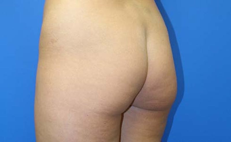 Brazilian Butt Lift Before & After Gallery - Patient 240079 - Image 9