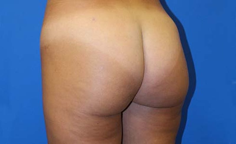 Brazilian Butt Lift Before & After Gallery - Patient 240079 - Image 10