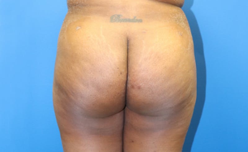 Brazilian Butt Lift Before & After Gallery - Patient 329419 - Image 1