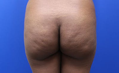 Brazilian Butt Lift Before & After Gallery - Patient 177227 - Image 1