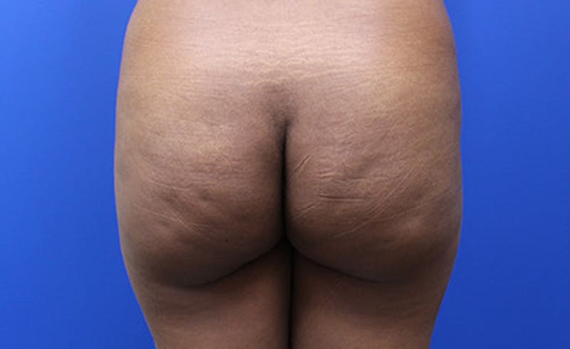 Brazilian Butt Lift Before & After Gallery - Patient 177227 - Image 1