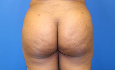 Brazilian Butt Lift Before & After Gallery - Patient 177227 - Image 2