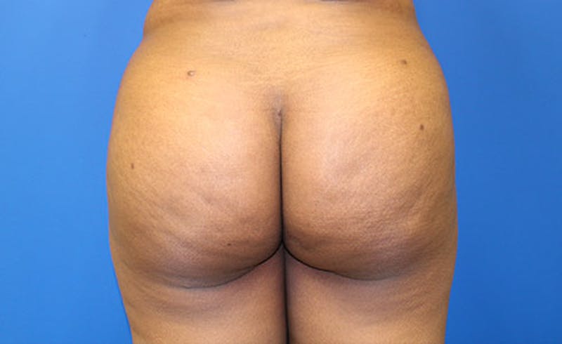 Brazilian Butt Lift Before & After Gallery - Patient 177227 - Image 2