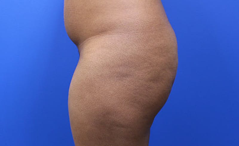 Brazilian Butt Lift Before & After Gallery - Patient 177227 - Image 3