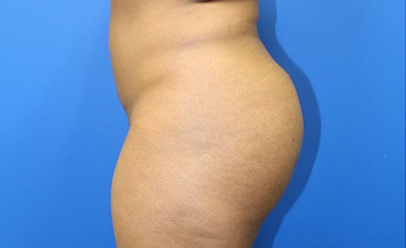 Brazilian Butt Lift Before & After Gallery - Patient 177227 - Image 4