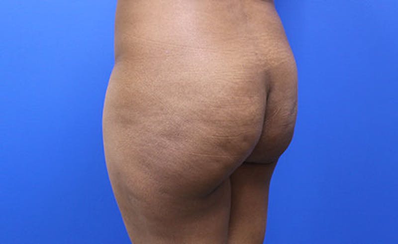 Brazilian Butt Lift Before & After Gallery - Patient 177227 - Image 5