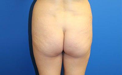 Brazilian Butt Lift Before & After Gallery - Patient 358332 - Image 1