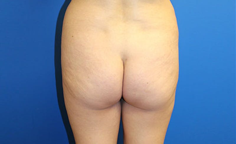 Brazilian Butt Lift Before & After Gallery - Patient 358332 - Image 1