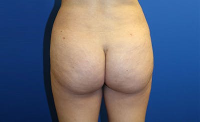 Brazilian Butt Lift Before & After Gallery - Patient 358332 - Image 2