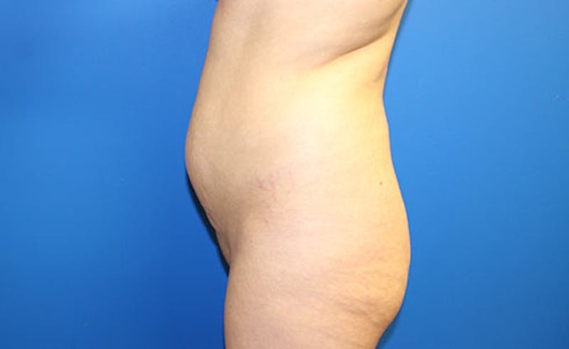 Brazilian Butt Lift Before & After Gallery - Patient 358332 - Image 3