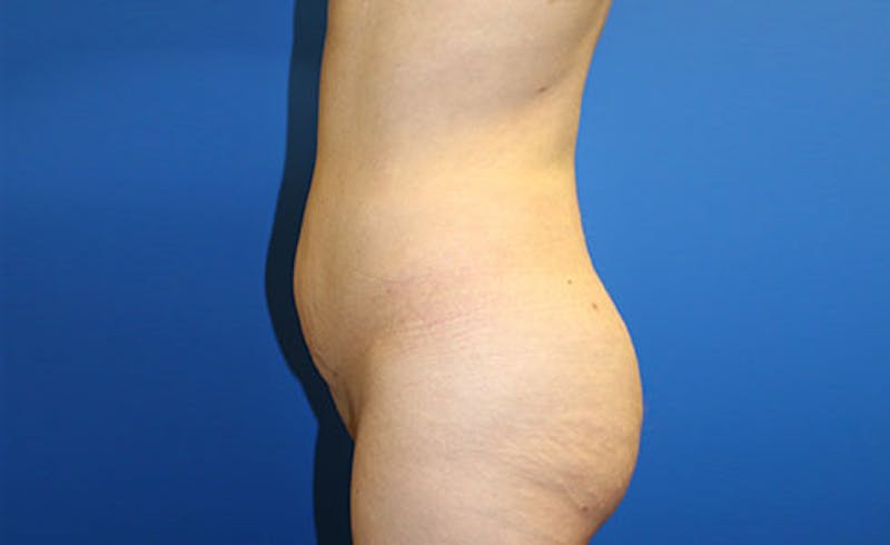 Brazilian Butt Lift Before & After Gallery - Patient 358332 - Image 4