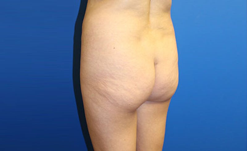 Brazilian Butt Lift Before & After Gallery - Patient 358332 - Image 5
