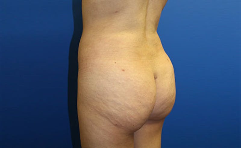 Brazilian Butt Lift Before & After Gallery - Patient 358332 - Image 6