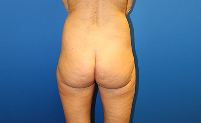 Brazilian Butt Lift Before & After Gallery - Patient 121659 - Image 1