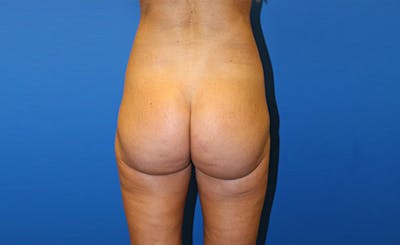 Brazilian Butt Lift Before & After Gallery - Patient 121659 - Image 2