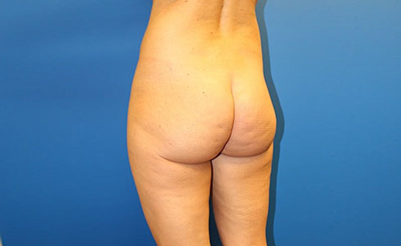 Brazilian Butt Lift Before & After Gallery - Patient 121659 - Image 3