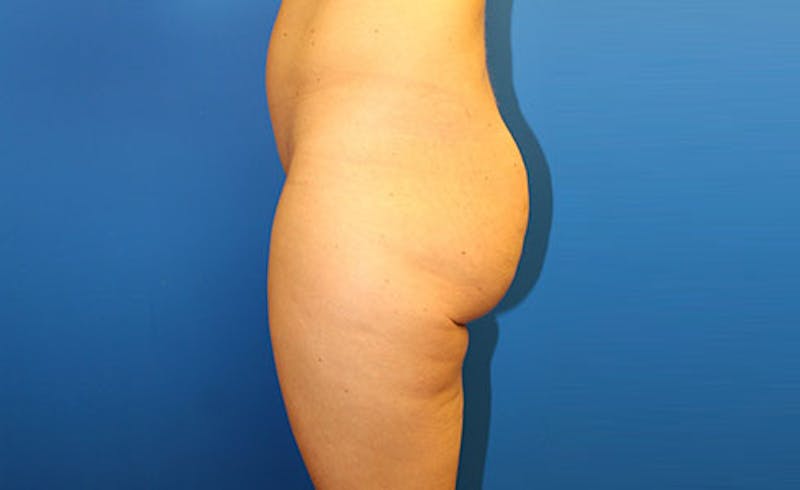 Brazilian Butt Lift Before & After Gallery - Patient 121659 - Image 5