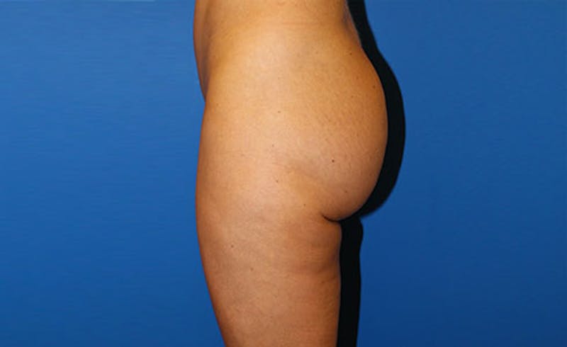 Brazilian Butt Lift Before & After Gallery - Patient 121659 - Image 6