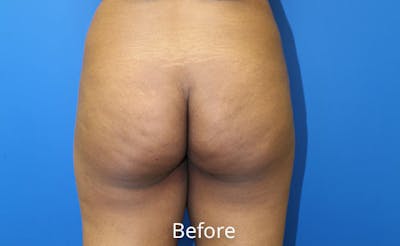 Brazilian Butt Lift Before & After Gallery - Patient 261007 - Image 1