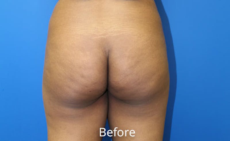 Brazilian Butt Lift Before & After Gallery - Patient 261007 - Image 1