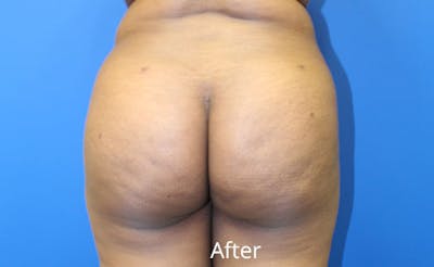 Brazilian Butt Lift Before & After Gallery - Patient 261007 - Image 2