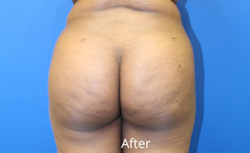 Brazilian Butt Lift Before & After Gallery - Patient 261007 - Image 2