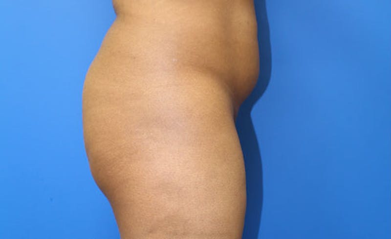 Brazilian Butt Lift Before & After Gallery - Patient 261007 - Image 3