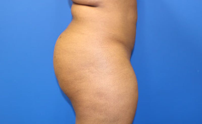 Brazilian Butt Lift Before & After Gallery - Patient 261007 - Image 4