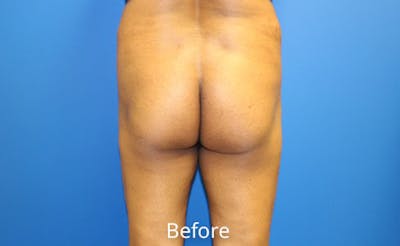 Brazilian Butt Lift Before & After Gallery - Patient 353245 - Image 1