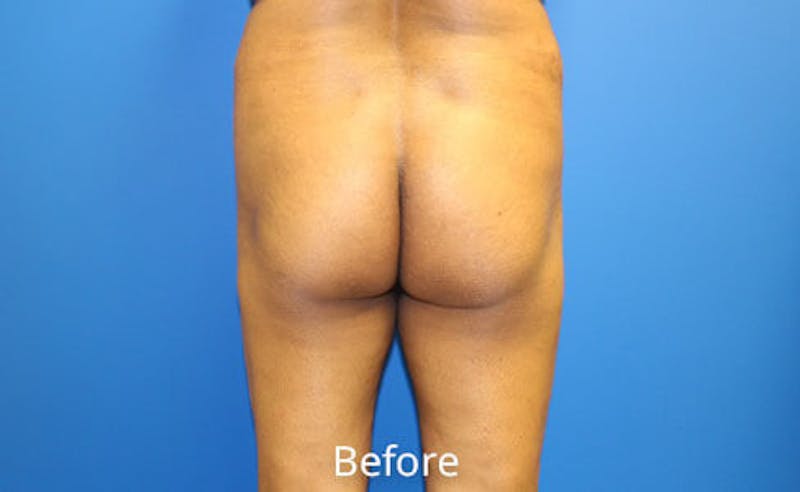 Brazilian Butt Lift Before & After Gallery - Patient 353245 - Image 1