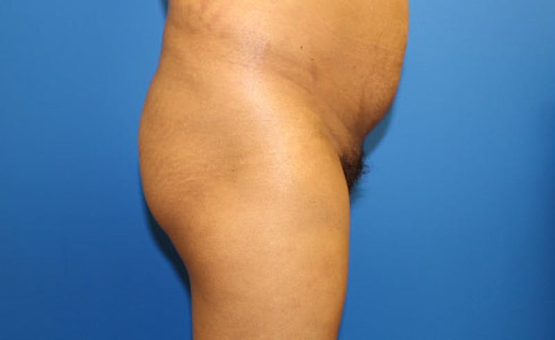 Brazilian Butt Lift Before & After Gallery - Patient 353245 - Image 3
