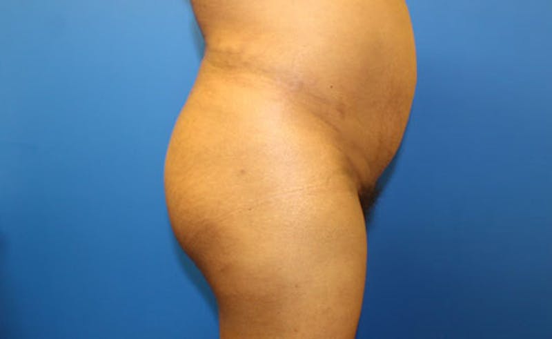 Brazilian Butt Lift Before & After Gallery - Patient 353245 - Image 4